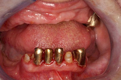 Beispiele für Verlust der Verankerung an Zähne bzw. Implantaten