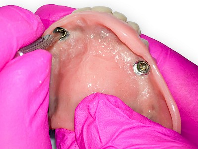 Beispiele für Verlust der Verankerung an Zähne bzw. Implantaten