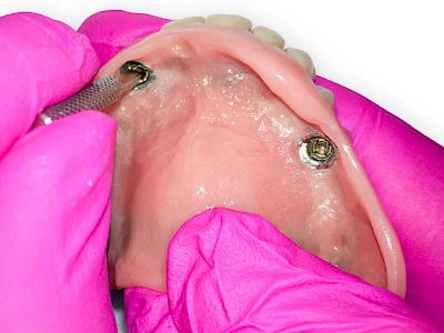Beispiele: Verlust der Verankerung an Zähne bzw. Implantaten